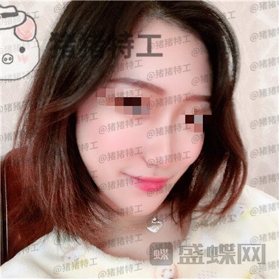武汉华美马行鼻部手术案例价格分享,优惠的价格竟然可以做的这么完美!
