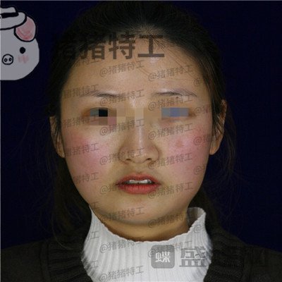 四川友谊张立天下颌角磨骨案例价格分享,脸小了一倍这改变太惊人了!
