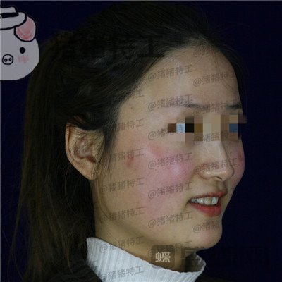 四川友谊张立天下颌角磨骨案例价格分享,脸小了一倍这改变太惊人了!