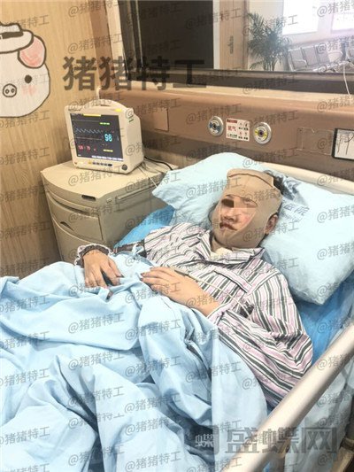 四川友谊张立天下颌角磨骨案例价格分享,脸小了一倍这改变太惊人了!