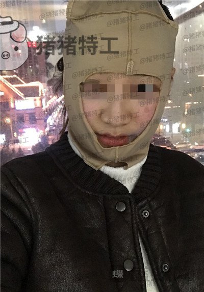 四川友谊张立天下颌角磨骨案例价格分享,脸小了一倍这改变太惊人了!