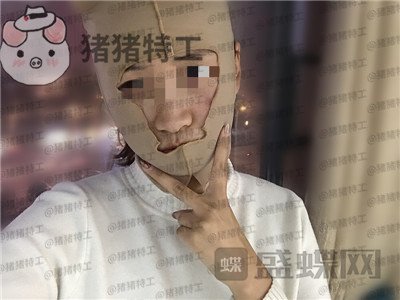 四川友谊张立天下颌角磨骨案例价格分享,脸小了一倍这改变太惊人了!