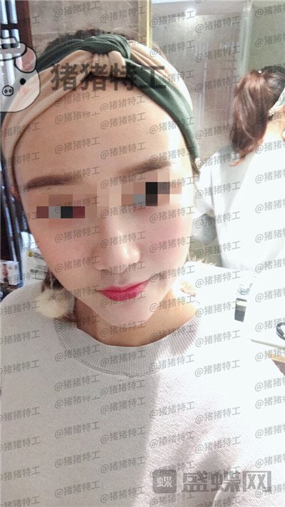 四川友谊张立天下颌角磨骨案例价格分享,脸小了一倍这改变太惊人了!