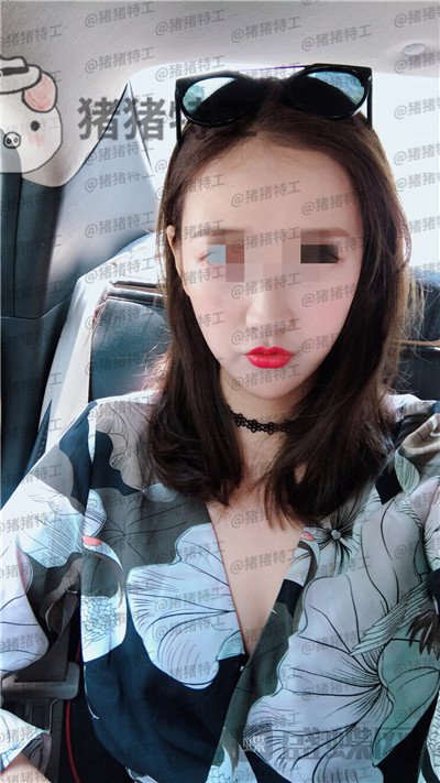 四川友谊张立天下颌角磨骨案例价格分享,脸小了一倍这改变太惊人了!