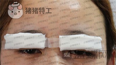 深圳博爱曙光白云双眼皮案例价格分享,这双眼睛具备了好看双眼皮的全部优点。