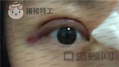 深圳博爱曙光白云双眼皮案例价格分享,这双眼睛具备了好看双眼皮的全部优点。