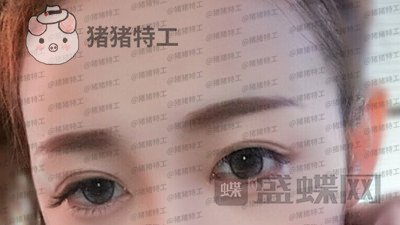 深圳博爱曙光白云双眼皮案例价格分享,这双眼睛具备了好看双眼皮的全部优点。
