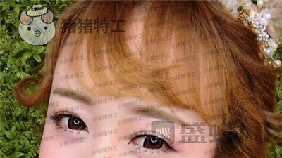 深圳博爱曙光白云双眼皮案例价格分享,这双眼睛具备了好看双眼皮的全部优点。