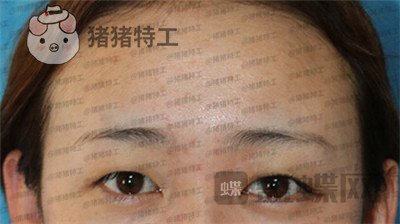 深圳博爱曙光白云双眼皮案例价格分享,这双眼睛具备了好看双眼皮的全部优点。