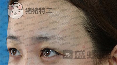 深圳博爱曙光白云双眼皮案例价格分享,这双眼睛具备了好看双眼皮的全部优点。