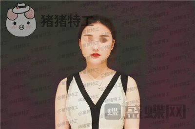 福州爱美尔张胜利鼻部手术案例价格分享,排预约等了这么久做成这样真的值了!
