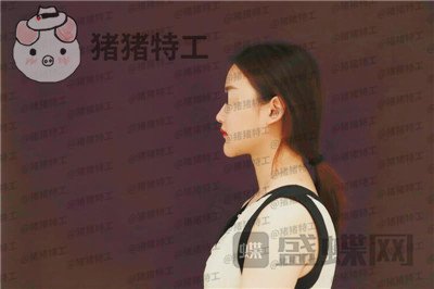 福州爱美尔张胜利鼻部手术案例价格分享,排预约等了这么久做成这样真的值了!