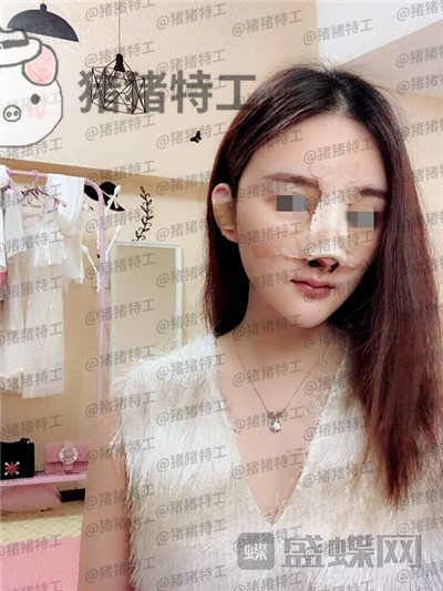 福州爱美尔张胜利鼻部手术案例价格分享,排预约等了这么久做成这样真的值了!