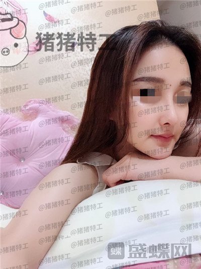 福州爱美尔张胜利鼻部手术案例价格分享,排预约等了这么久做成这样真的值了!