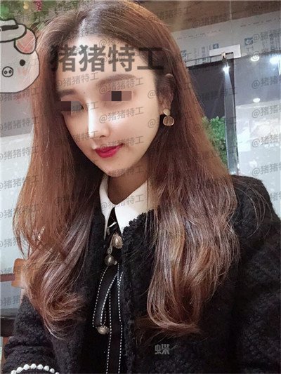 福州爱美尔张胜利鼻部手术案例价格分享,排预约等了这么久做成这样真的值了!