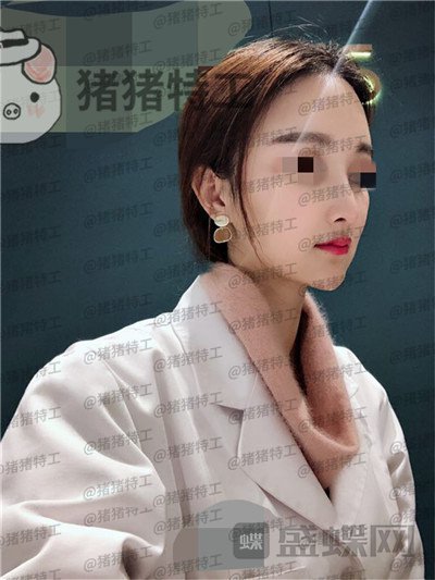 福州爱美尔张胜利鼻部手术案例价格分享,排预约等了这么久做成这样真的值了!