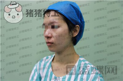 杭州同荣丽格郭同荣面部填充案例价格分享,在公司上班保洁阿姨以为我是高中生~