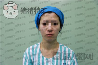 杭州同荣丽格郭同荣面部填充案例价格分享,在公司上班保洁阿姨以为我是高中生~