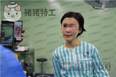 杭州同荣丽格郭同荣面部填充案例价格分享,在公司上班保洁阿姨以为我是高中生~