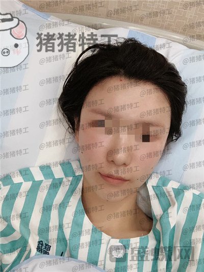杭州同荣丽格郭同荣面部填充案例价格分享,在公司上班保洁阿姨以为我是高中生~