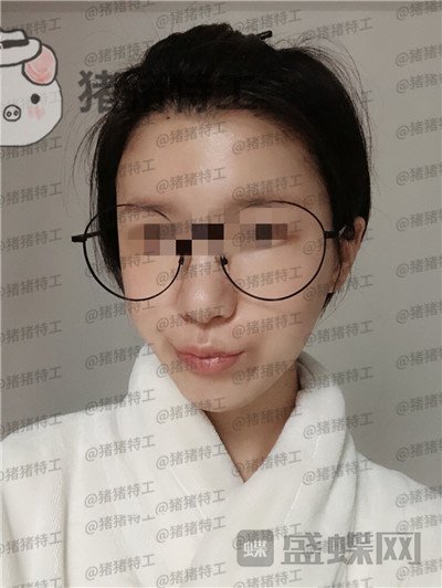 杭州同荣丽格郭同荣面部填充案例价格分享,在公司上班保洁阿姨以为我是高中生~