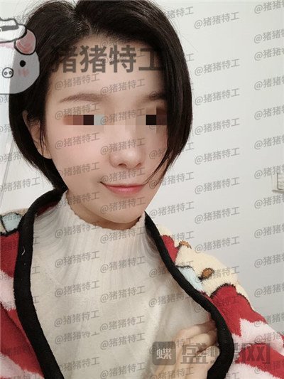 杭州同荣丽格郭同荣面部填充案例价格分享,在公司上班保洁阿姨以为我是高中生~