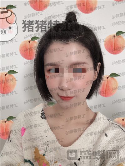 杭州同荣丽格郭同荣面部填充案例价格分享,在公司上班保洁阿姨以为我是高中生~