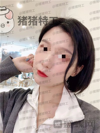 杭州同荣丽格郭同荣面部填充案例价格分享,在公司上班保洁阿姨以为我是高中生~