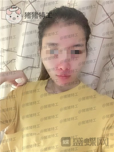 天津南开区奥薇和谐丛相文面部填充案例价格分享,这个果目前为止我很满意~