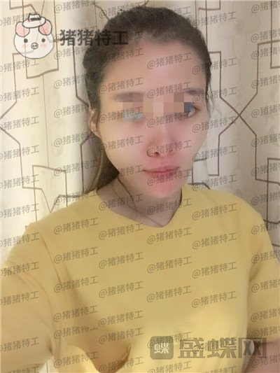 天津南开区奥薇和谐丛相文面部填充案例价格分享,这个果目前为止我很满意~