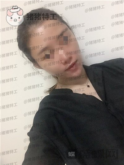 天津南开区奥薇和谐丛相文面部填充案例价格分享,这个果目前为止我很满意~
