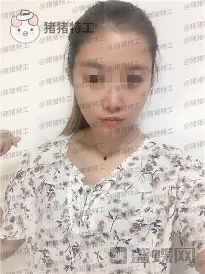 天津南开区奥薇和谐丛相文面部填充案例价格分享,这个果目前为止我很满意~