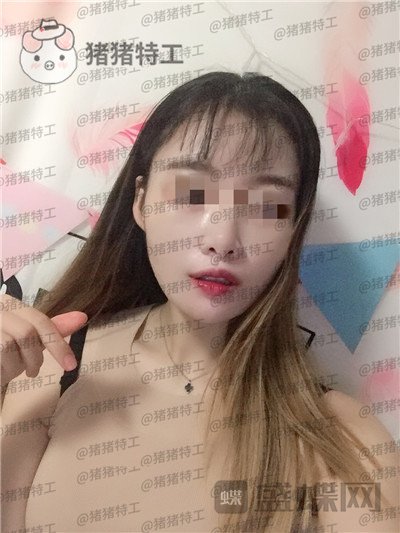 天津南开区奥薇和谐丛相文面部填充案例价格分享,这个果目前为止我很满意~