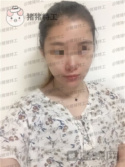 天津南开区奥薇和谐丛相文面部填充案例价格分享,这个果目前为止我很满意~