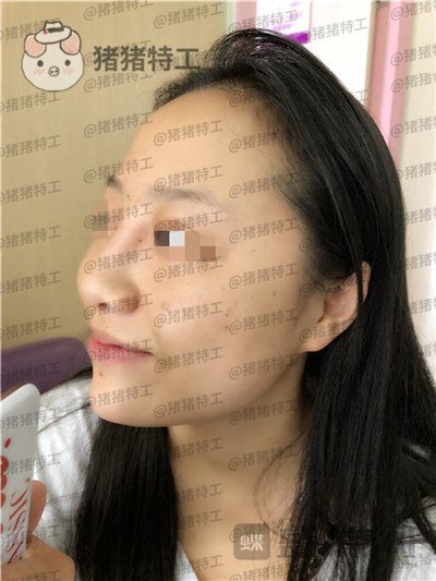 云南华美美莱洪晓娅鼻部手术案例价格分享,果然鼻子高了不化妆都很好看!