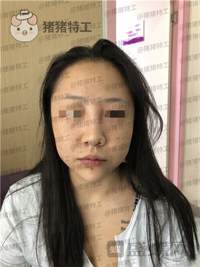 云南华美美莱洪晓娅鼻部手术案例价格分享,果然鼻子高了不化妆都很好看!
