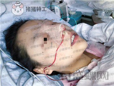 云南华美美莱洪晓娅鼻部手术案例价格分享,果然鼻子高了不化妆都很好看!