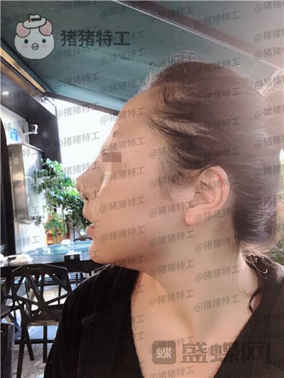 云南华美美莱洪晓娅鼻部手术案例价格分享,果然鼻子高了不化妆都很好看!