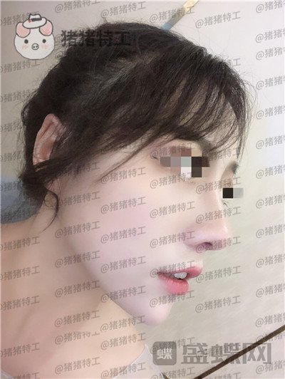 云南华美美莱洪晓娅鼻部手术案例价格分享,果然鼻子高了不化妆都很好看!