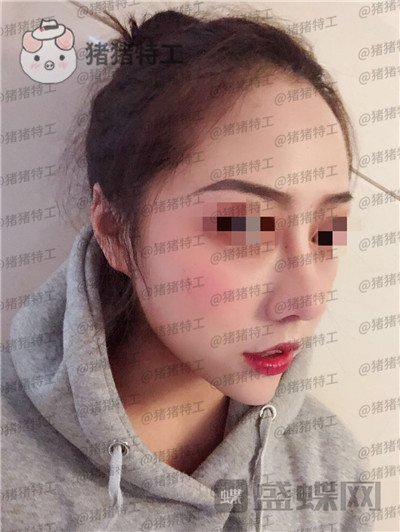 云南华美美莱洪晓娅鼻部手术案例价格分享,果然鼻子高了不化妆都很好看!