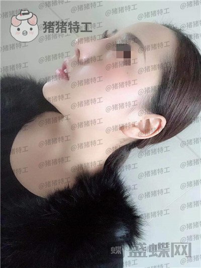云南华美美莱洪晓娅鼻部手术案例价格分享,果然鼻子高了不化妆都很好看!