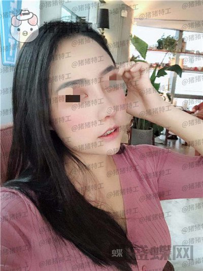 云南华美美莱洪晓娅鼻部手术案例价格分享,果然鼻子高了不化妆都很好看!