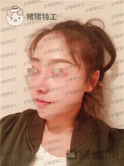 云南华美美莱洪晓娅鼻部手术案例价格分享,果然鼻子高了不化妆都很好看!