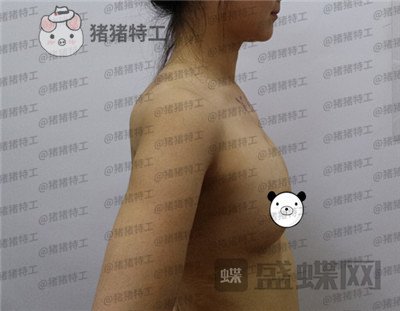 北京英煌项力源隆胸案例价格分享,不仅增大还改善掉下垂真的太惊讶啦!
