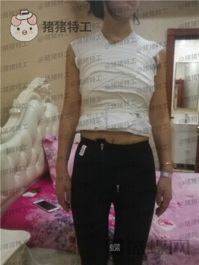 北京英煌项力源隆胸案例价格分享,不仅增大还改善掉下垂真的太惊讶啦!