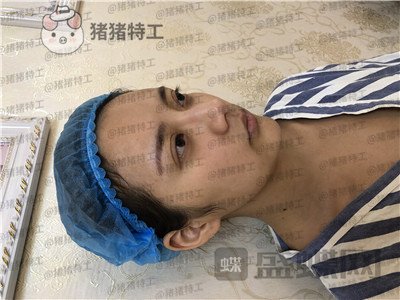 杭州伊琳毛琪面部填充案例价格分享,这个改变我说年轻十几岁不夸张吧!