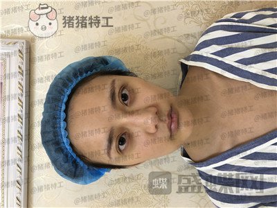 杭州伊琳毛琪面部填充案例价格分享,这个改变我说年轻十几岁不夸张吧!