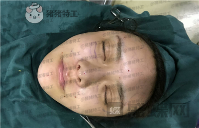 杭州伊琳毛琪面部填充案例价格分享,这个改变我说年轻十几岁不夸张吧!