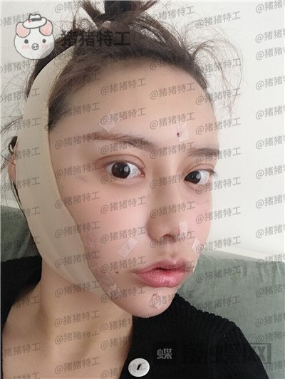 杭州伊琳毛琪面部填充案例价格分享,这个改变我说年轻十几岁不夸张吧!