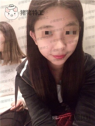 重庆木槿张平隆鼻案例价格分享,做完我都觉得自己太可爱了~